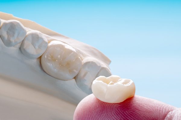 dental crowns and bridges seven hills