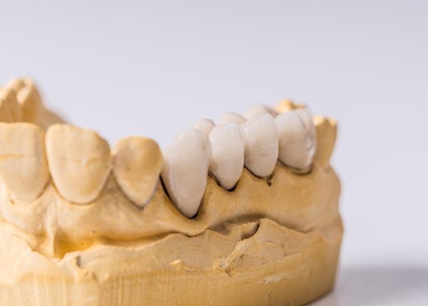 types of dental bridges seven hills