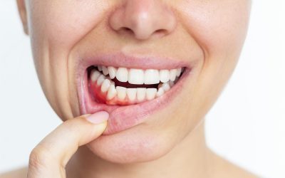 Why do my gums bleed?